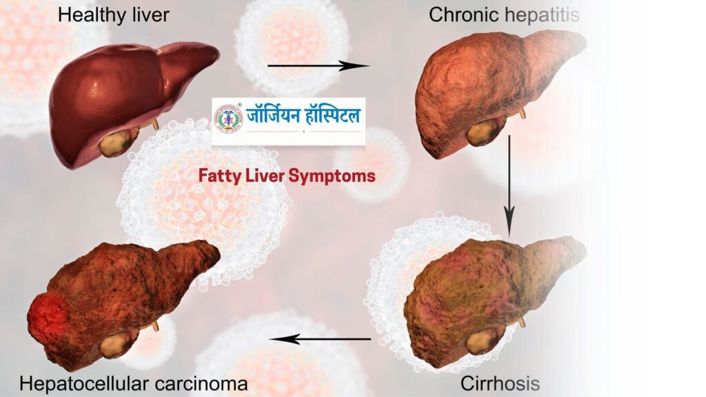 Fatty Liver - Georgian Hospital